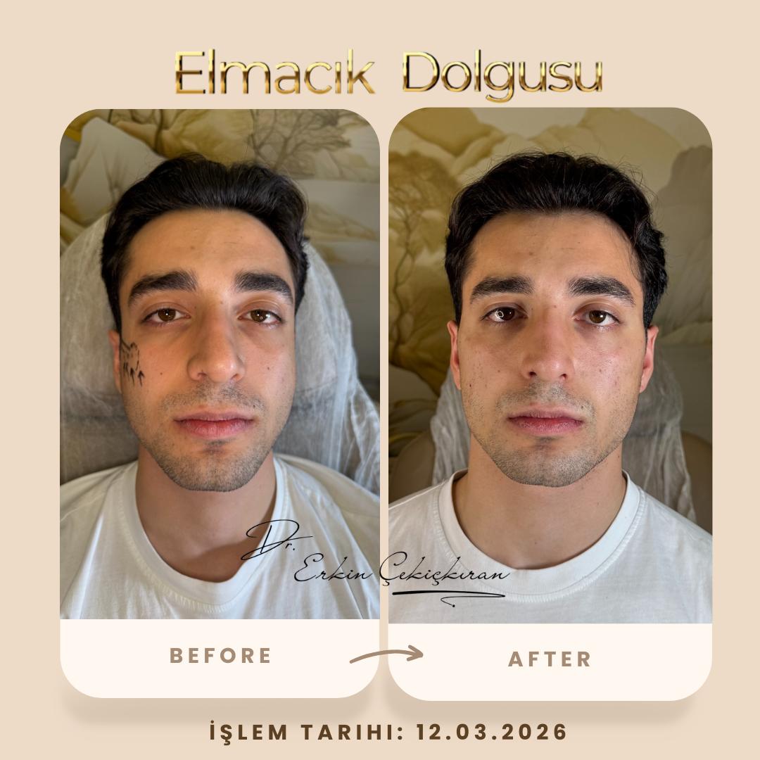 Elmacık Dolgusu öncesi ve sonrası