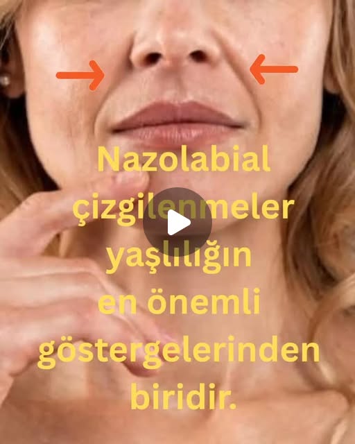 Nazolabial Dolgu
