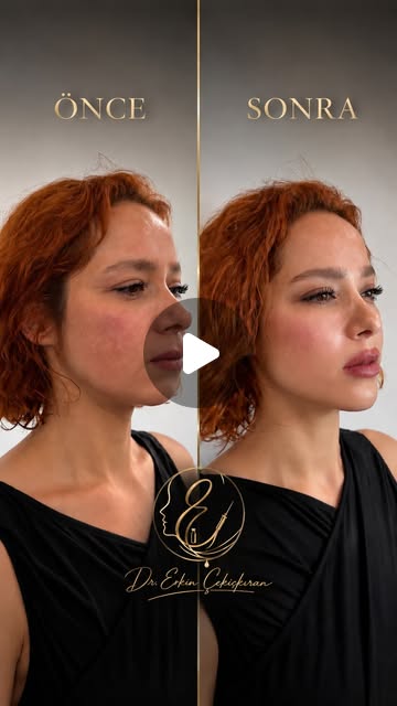 Jawline ve Çene Tasarımı