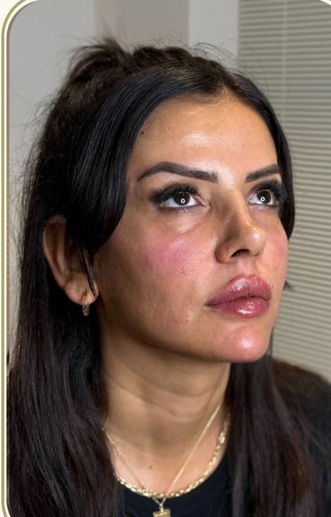 Full face uygulaması sonrası