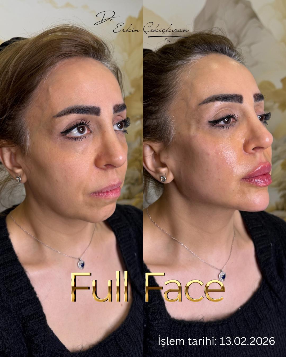 Full Face öncesi ve sonrası