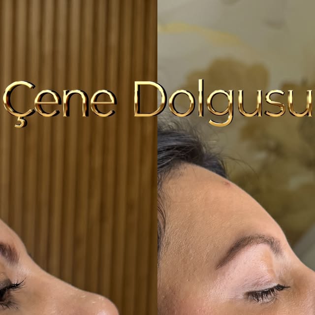 Çene Dolgusu