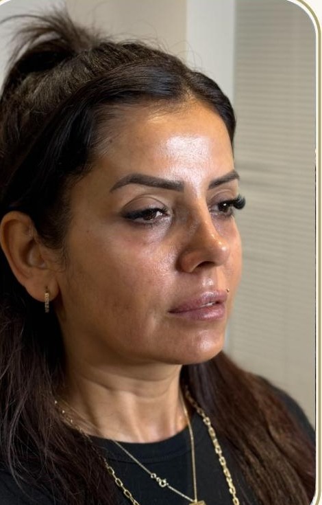Full face uygulaması öncesi