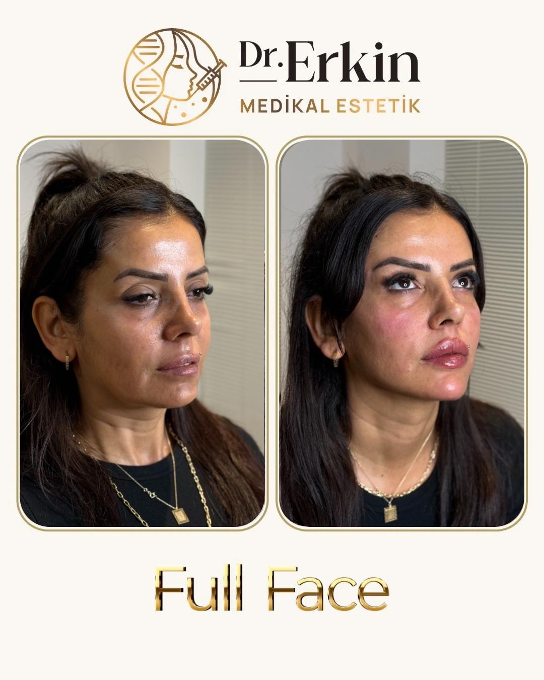 Full Face öncesi ve sonrası