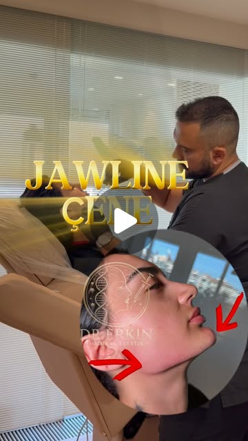 Jawline Dolgusu